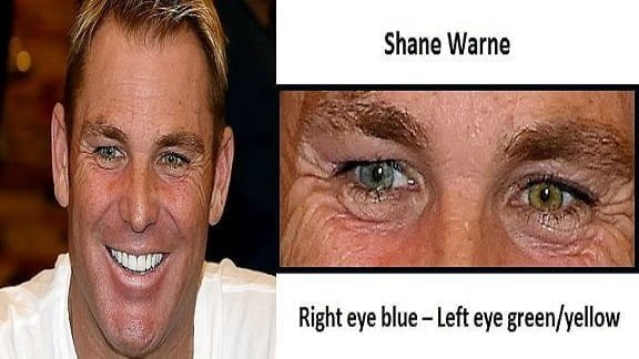 Untitled 2 8 શેન વોર્નની બંને આંખોના રંગ કેમ અલગ હતા ?  એક વાદળી અને બીજી લીલી, જાણો શું છે કારણ