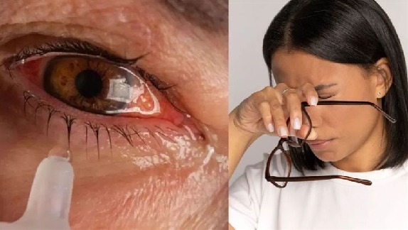 Conjunctivitis spreads in these 5 ways, know the symptoms and ways to avoid it
