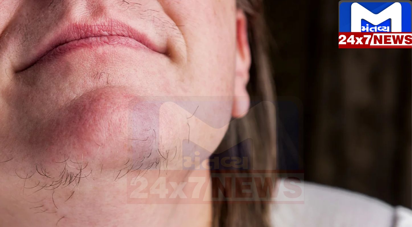 Image 61 1 મહિલાઓને કયા કારણોથી ચહેરા પર વાળ ઊગે છે? લક્ષણોને ઓળખો