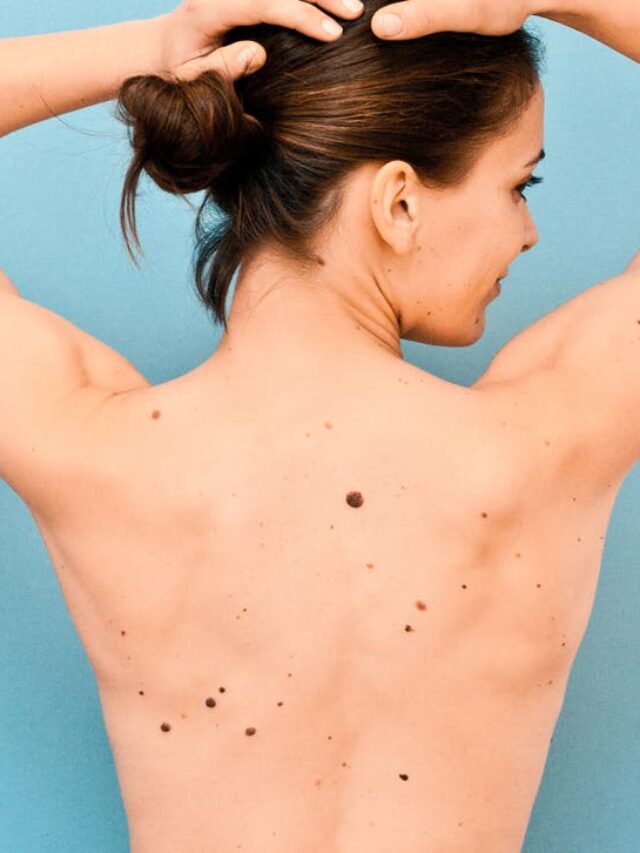 moles-on-your-body-meaning