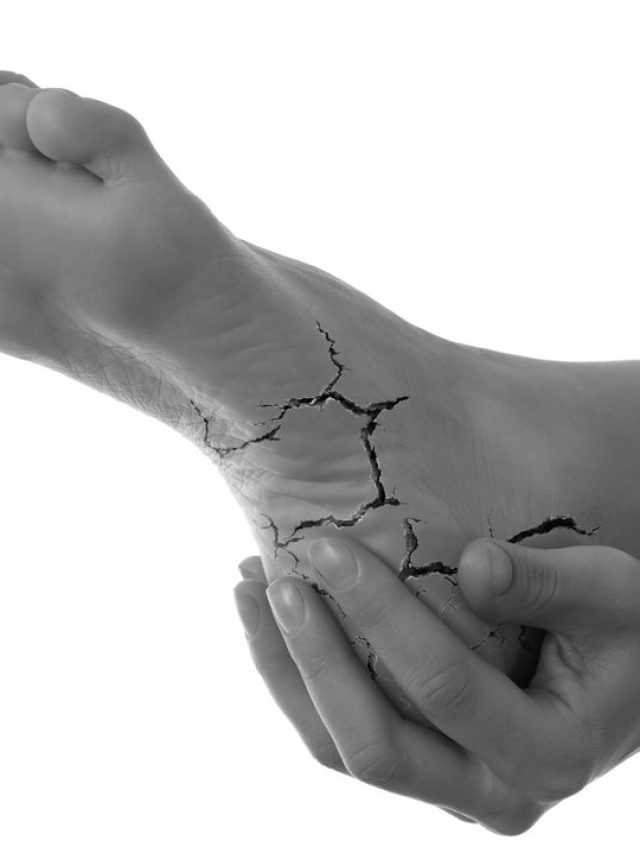 Cracked-heel-image-e1554297634476