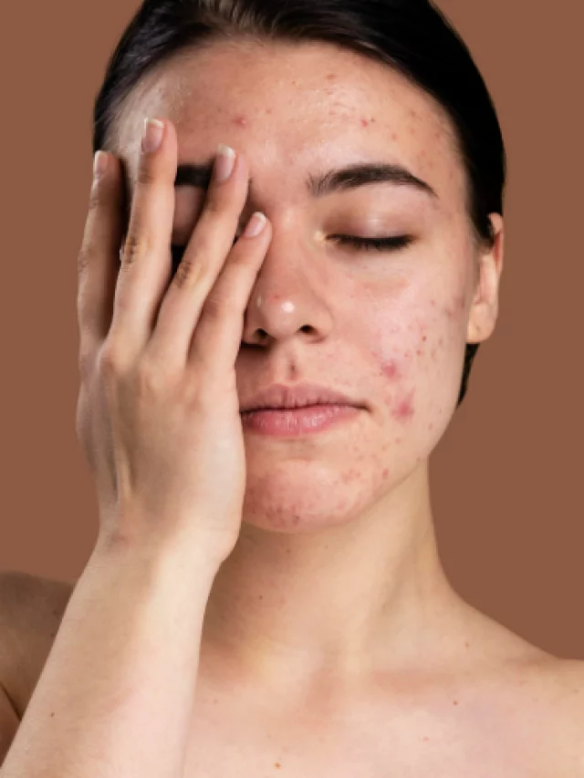 Homemade-Face-Pack-for-Pimples