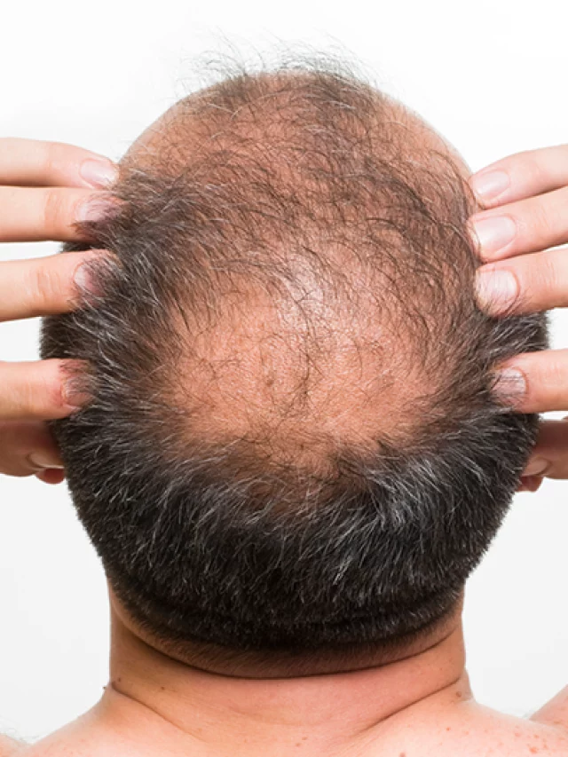 HH_MalePatternBaldness_Text_Image.dam.ts=1701768553240