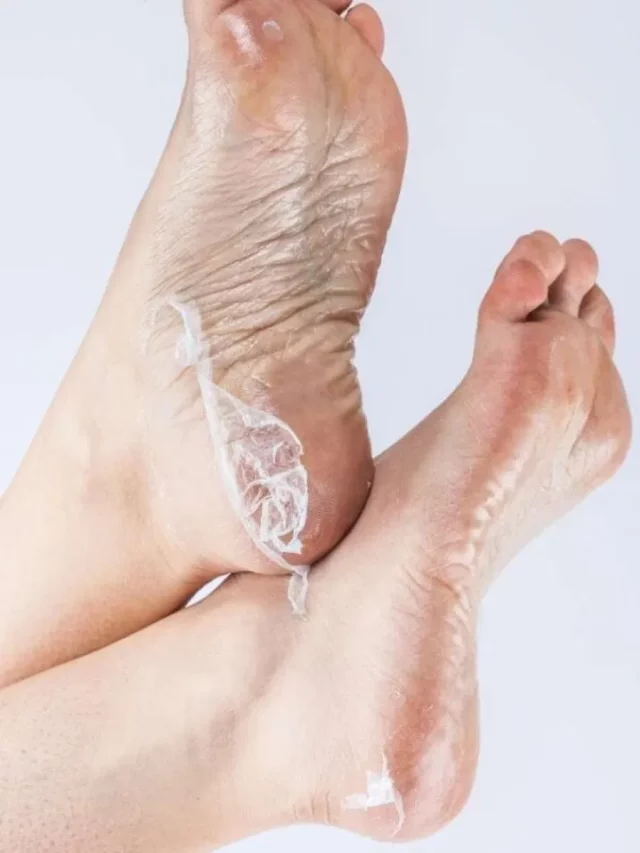 cropped-home-remedies-for-cracked-heels-1744018340-1