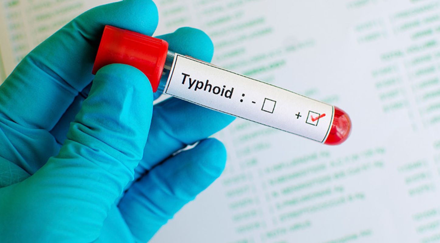 Typhoid