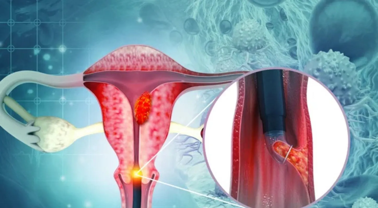 Cervical Cancer,સર્વાઇકલ કેન્સર, ભારત, મહિલા, મૃત્યુ