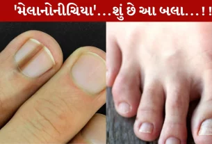Black Lines on Nails,નખ પર કાળી લાઈન થવી, વિટામિન, ઉણપ, કેન્સર