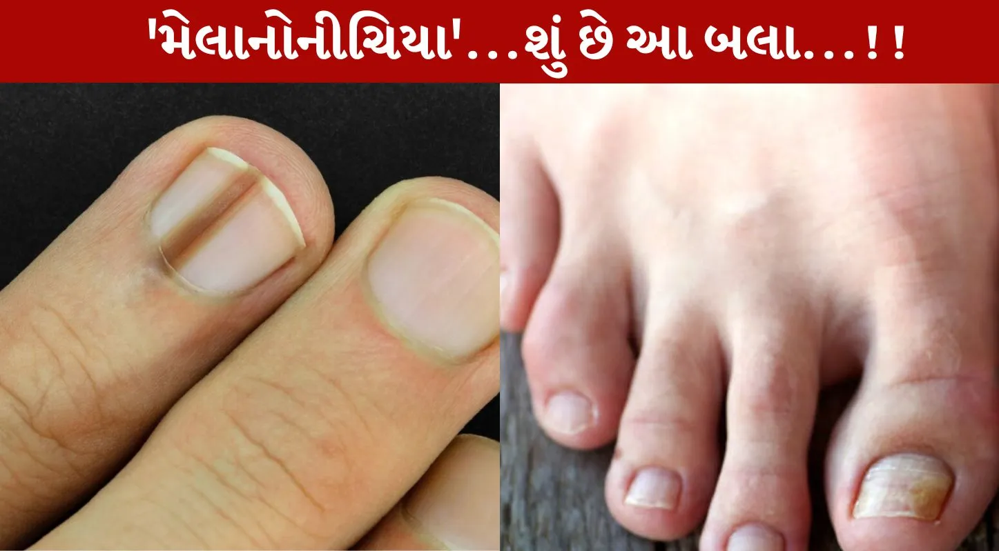 Black Lines on Nails,નખ પર કાળી લાઈન થવી, વિટામિન, ઉણપ, કેન્સર