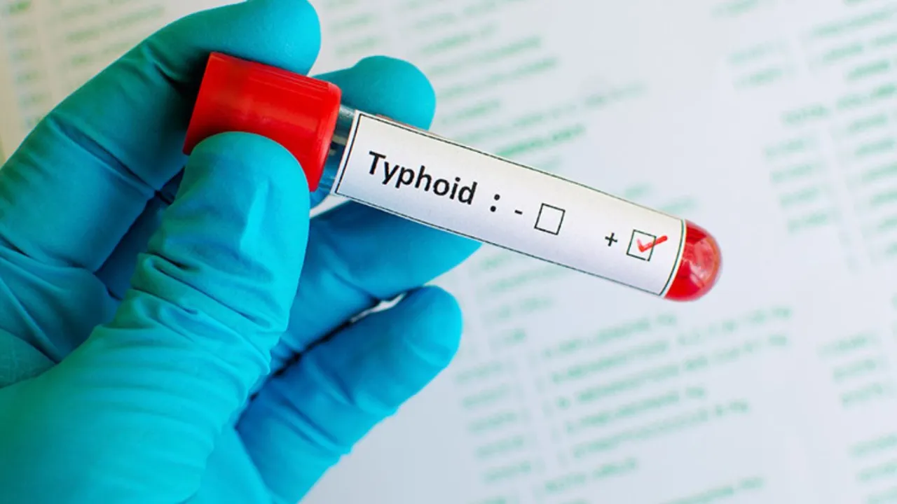 Typhoid
