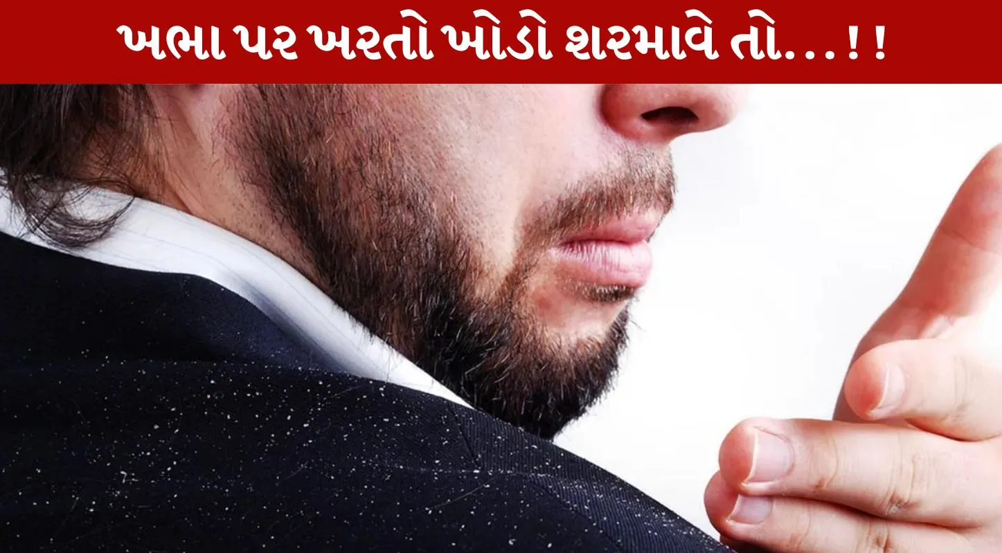 Dandruff, ખોડો, વાળ, એલોવેરા, ટિપ્સ