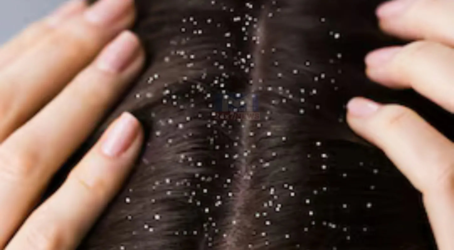 Hair Problems, વાળની સમસ્યાઓ, મેથી-સરસવનું તેલ, ખોડો, સ્કૅલ્પ ઇન્ફેક્શન