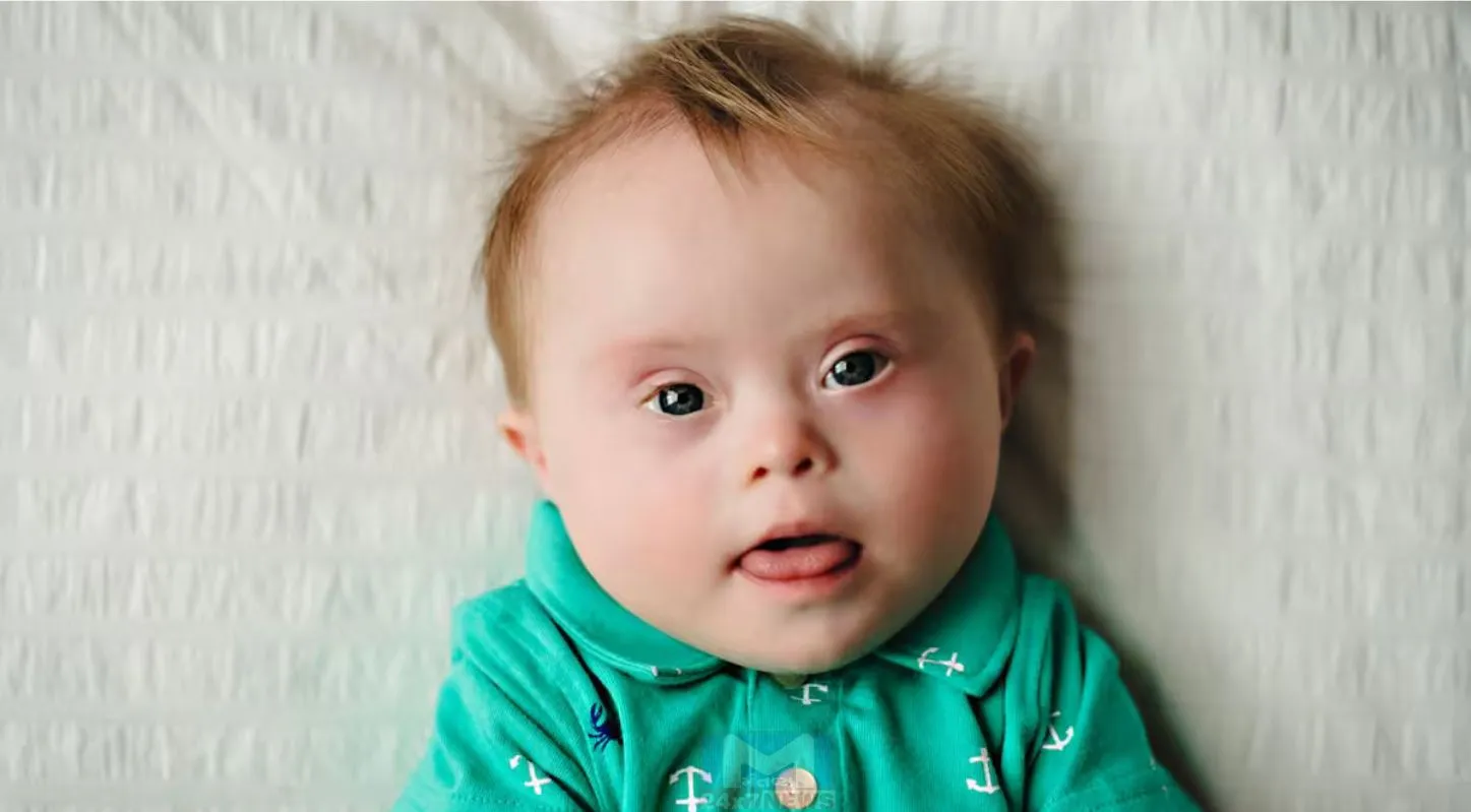 World Down Syndrome Day, ચપટો ચહેરો, તિરછી આંખ, આનુવંશિક વિકાર, બાળક