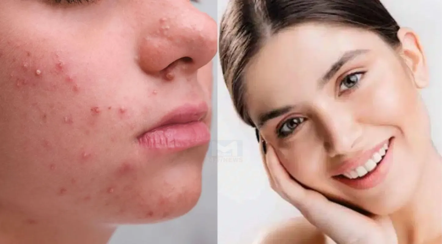 Sattu Face Pack, મૃત કોષો, સ્કિન કેર, ગુલાબ જળ, શેકેલા ચણા