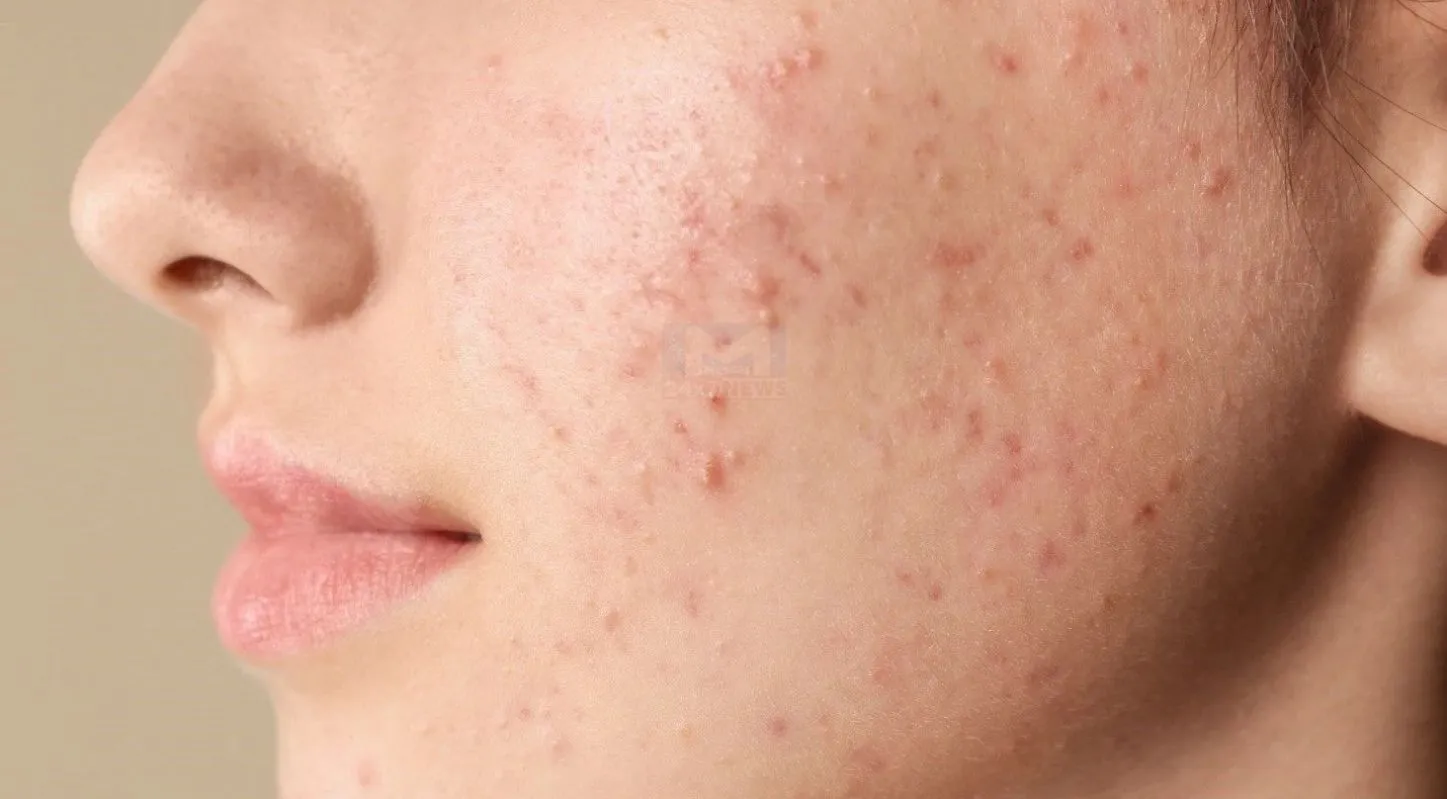 Sattu Face Pack, મૃત કોષો, સ્કિન કેર, ગુલાબ જળ, શેકેલા ચણા