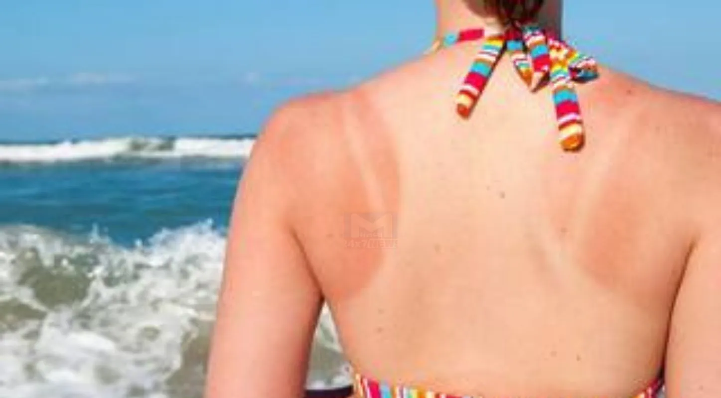 Skin Tanning , ઉનાળા, તડકા, સ્કિન બળે, ઘરગથ્થુ નુસખા
