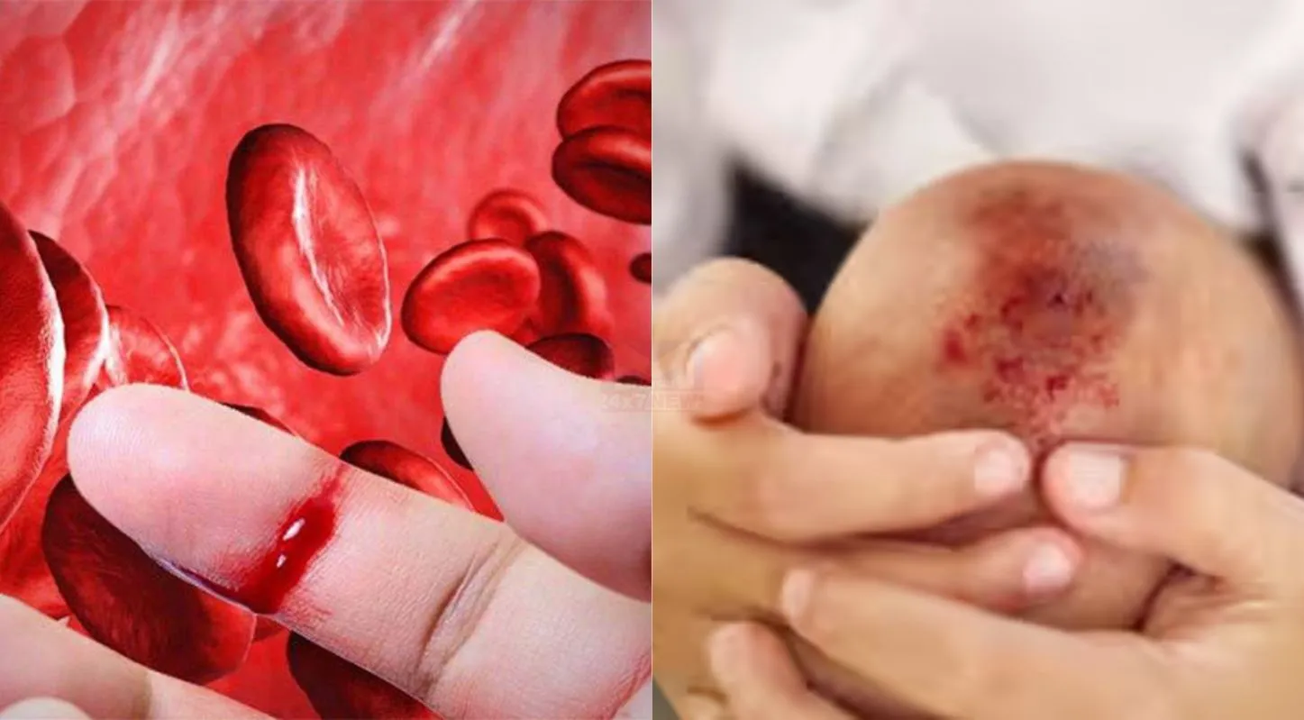 World Hemophilia Day 2026, ઈજા, લોહી ન ગંઠાવું, રોગ, રક્તસ્ત્રાવ