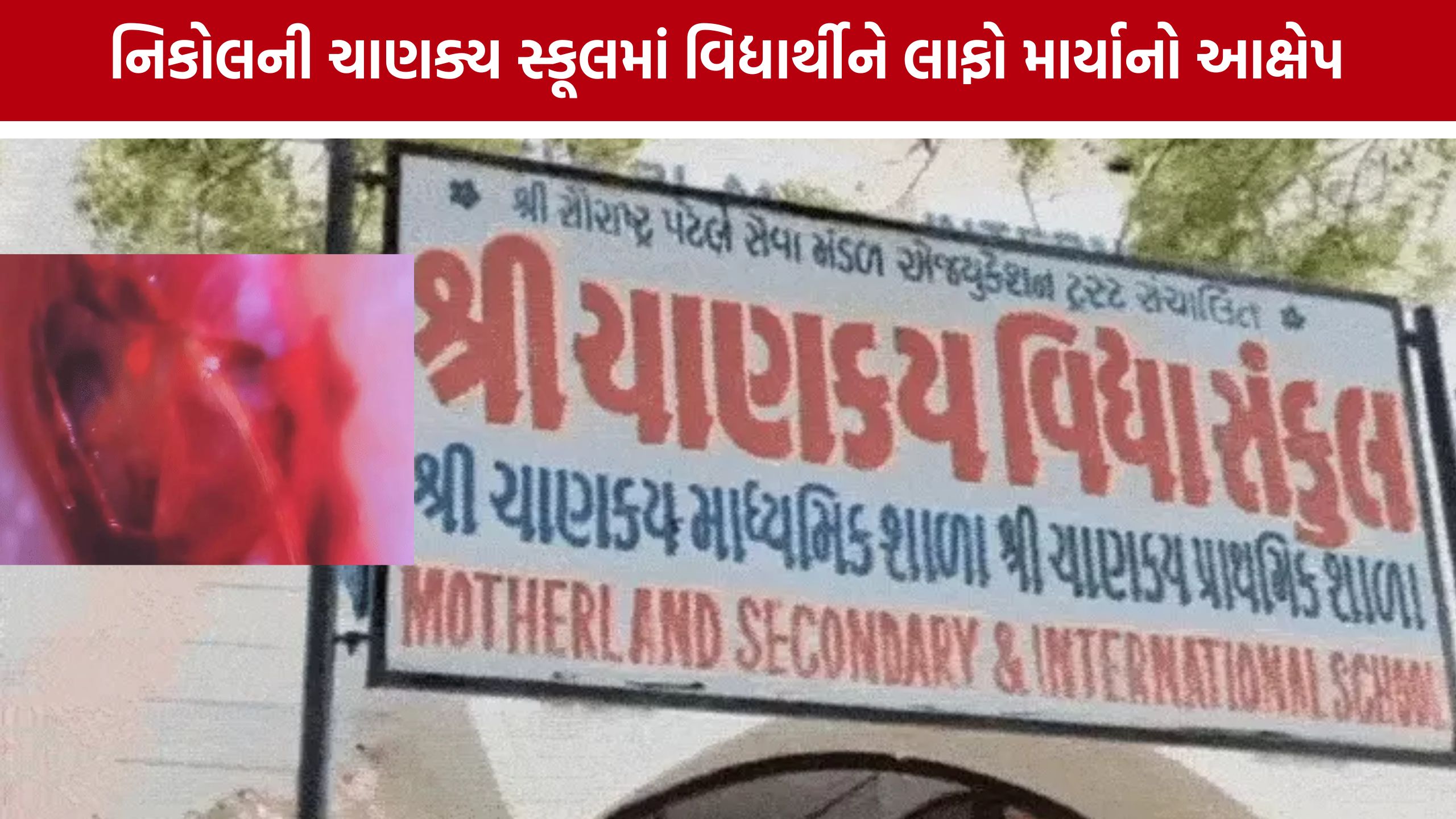 Ahmedabad Chanakya School : શિક્ષકના તમાચા બાદ વિદ્યાર્થીને કાનની તકલીફ