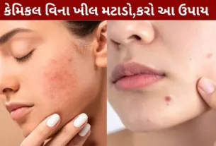 Beauty Tips Cure acne without chemicals.