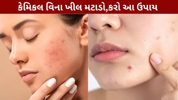 Beauty Tips Cure acne without chemicals.