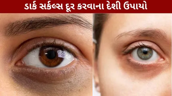 Get permanent relief from dark circles.