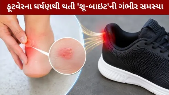 The serious problem of 'shoe-bite' caused by footwear friction.