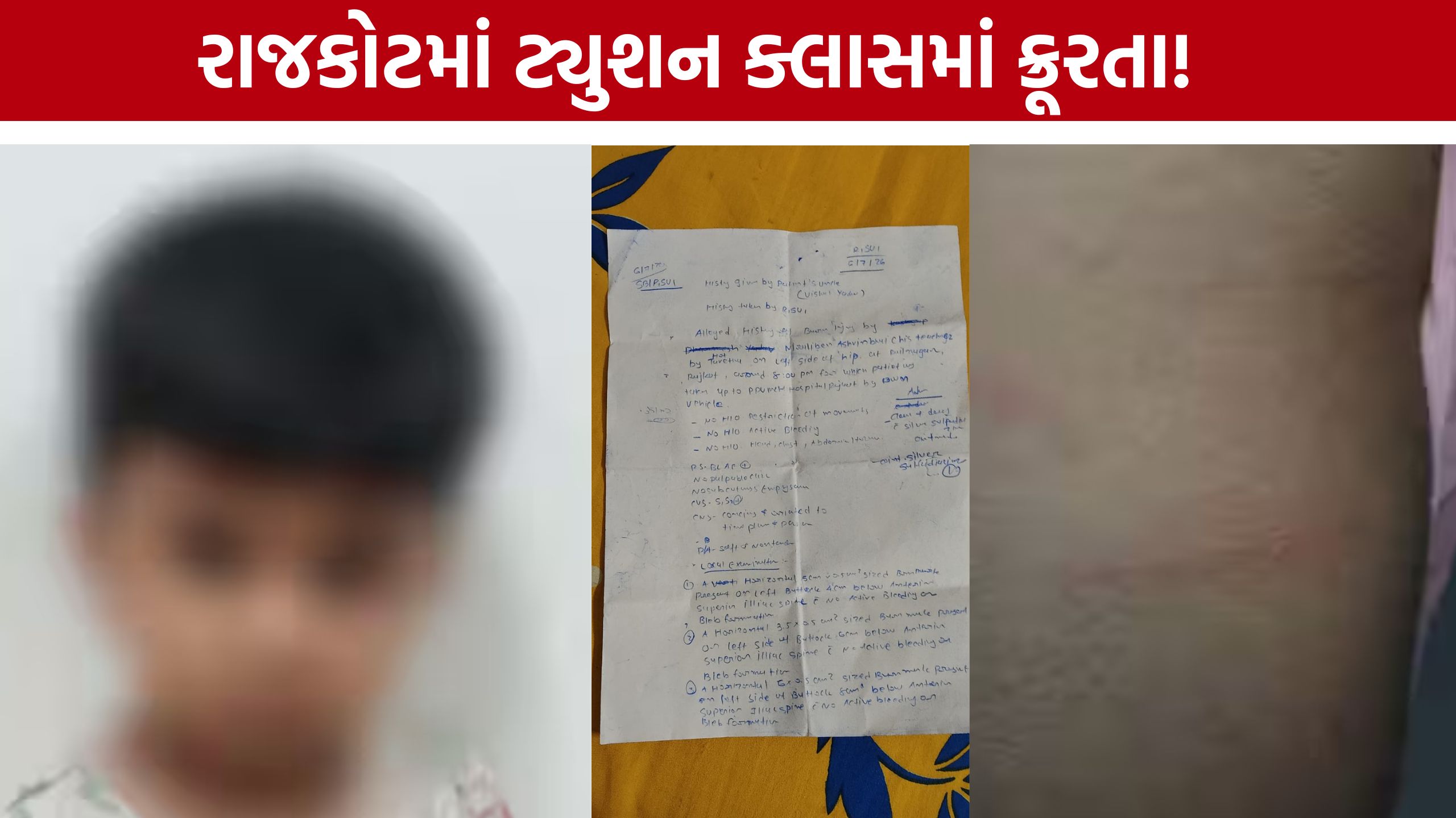 Rajkot Tuition Teacher પર બાળકને ડામ આપ્યાનો આરોપ, પોલીસ તપાસ શરૂ