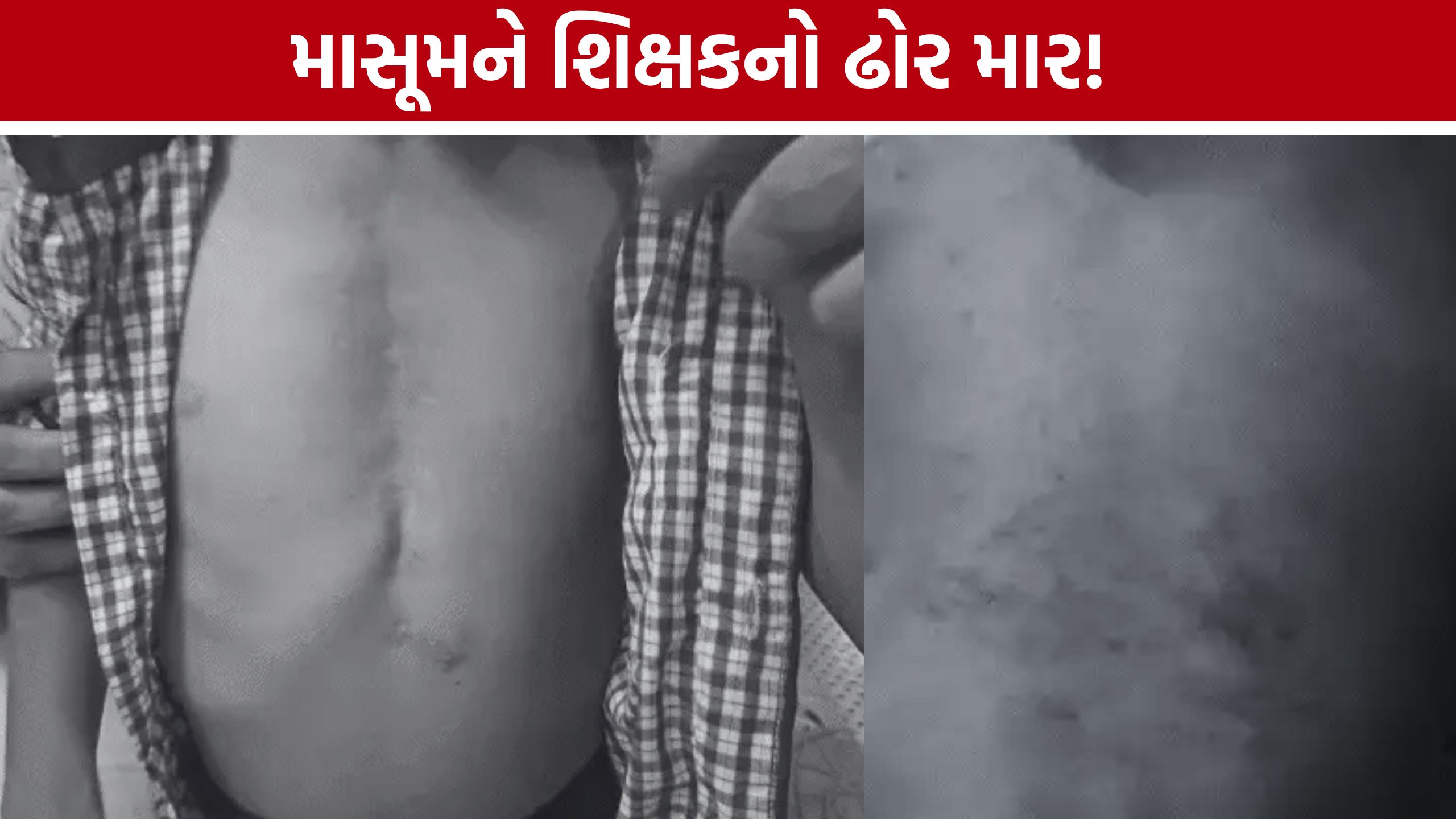Student Beating Case:ઓપન હાર્ટ સર્જરી થયેલા 6 વર્ષના બાળકને સોટીથી માર