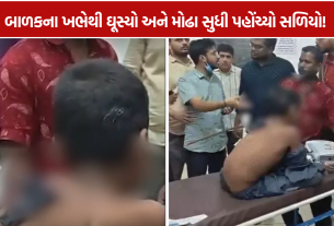 Surat Child Accident: 11 વર્ષના કિશોરના ખભેથી ઘૂસેલો સળિયો મોઢામાંથી આરપાર