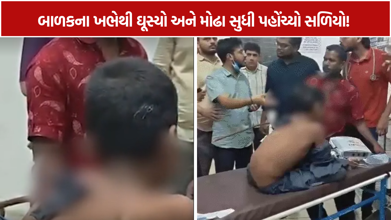 Surat Child Accident: 11 વર્ષના કિશોરના ખભેથી ઘૂસેલો સળિયો મોઢામાંથી આરપાર