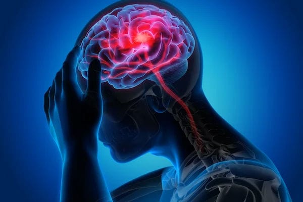 Dengue Brain Stroke: ડેન્ગ્યુમાં બ્રેન સ્ટ્રોકનો ખતરો કેટલો?