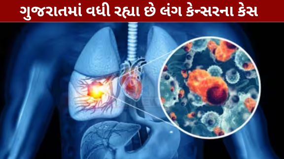 1 ઓગસ્ટ વિશ્વ લંગ કેન્સર દિવસ 2026 (World Lung Cancer Day 2026) :મુખ્યમંત્રી  ભૂપેન્દ્ર પટેલના માર્ગદર્શન અને આરોગ્ય મંત્રી પ્રફુલ પાનશેરિયાના નેતૃત્વ હેઠળ રાજ્ય સરકાર નાગરિકોને કેન્સર જેવી ગંભીર બીમારીઓ સામે શ્રેષ્ઠ અને અદ્યતન સારવાર પૂરી પાડવા માટે સતત કટિબદ્ધ છે.