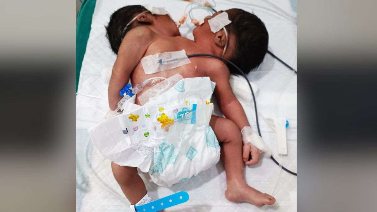 Odisha Conjoined Twins: જોડિયા બાળકોનો જન્મ, હૃદય અને લિવર એક જ