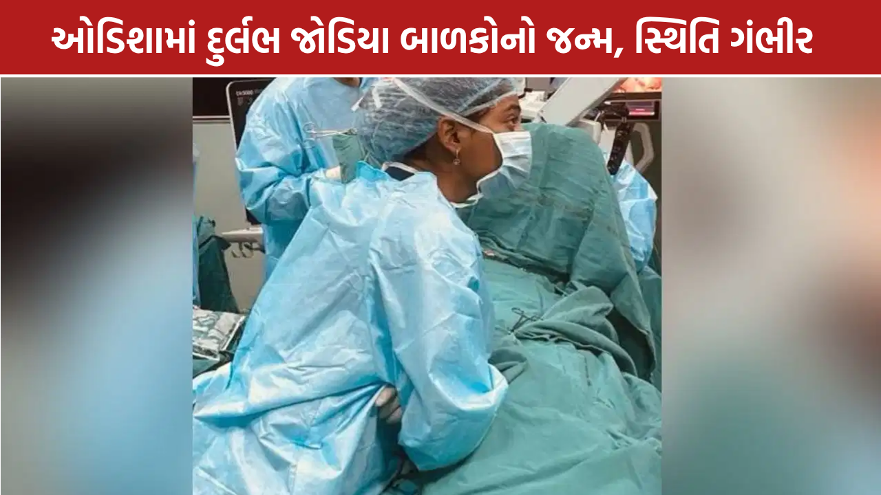 Odisha Conjoined Twins: જોડિયા બાળકોનો જન્મ, હૃદય અને લિવર એક જ